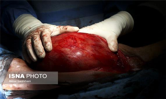 برداشتن توده 9 کیلویی از بدن بیمار 78 ساله در یاسوج